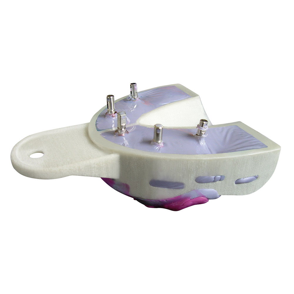 Hager & Werken Miratray Implant UK I1 6St Set